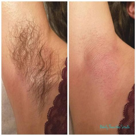 Before and after underarm wax! I recommend starting this in the winter months when we wear long sleeves so that we can hide our hair growth! It'll be thinned out come short sleeve weather. #dayton #ohio #brazilianwaxing #waxspecialist #waxing #esthetician #mensbrazilianwaxing #eyebrowwaxing #waxpro #beforeandafter #underarmwax Waxing Before And After, Waxing Esthetician, Natural Eyebrows Growth, Underarm Waxing, Wax Studio, Ingrown Hair Removal, Waxing Salon, Shaving Tips, Womens Health Care