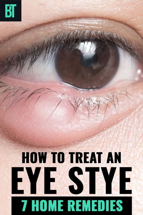 7 home remedies for an eye stye. How to treat an eye stye at home to get rid of it quickly. Read also about the causes and types of an eye stye that appears on adults and kids. Get Rid Of Stye, Stye Remedy, Eye Stye Remedies, Back Acne Remedies, Blind Pimple, Bad Acne, Pimples Remedies, Natural Acne Remedies, How To Get Rid Of Pimples