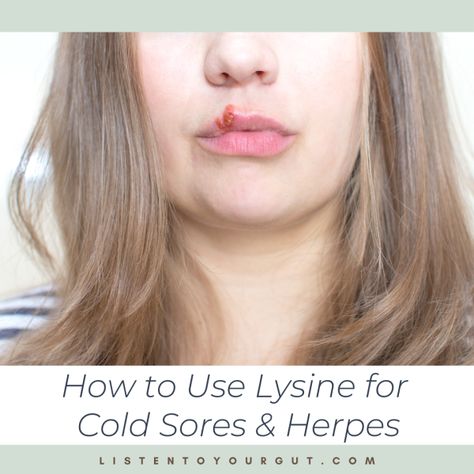 L Lysine Benefits Cold Sore, Cold Sores On Lips, Benefits Of Lysine, Lysine For Cold Sores, Cold Sore Remedy Fast, L Lysine Benefits, Cold Sore Lip, Remedies For Dry Mouth, Vertigo Remedies