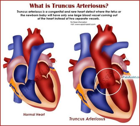 Truncus Arteriosus - Aorta + Pulmonary Arrery coming as one ... Therefore obviously - Ductus Dependent blood flow is not required ... 【 Note: Right Aortic arch is most commonly  a/w Truncus Arteriosus 】 Truncus Arteriosus, Aortic Arch, Cardiac Surgeon, Heart Warrior, Chd Awareness, Normal Heart, Congenital Heart Defect, Heart Defect, Congenital Heart