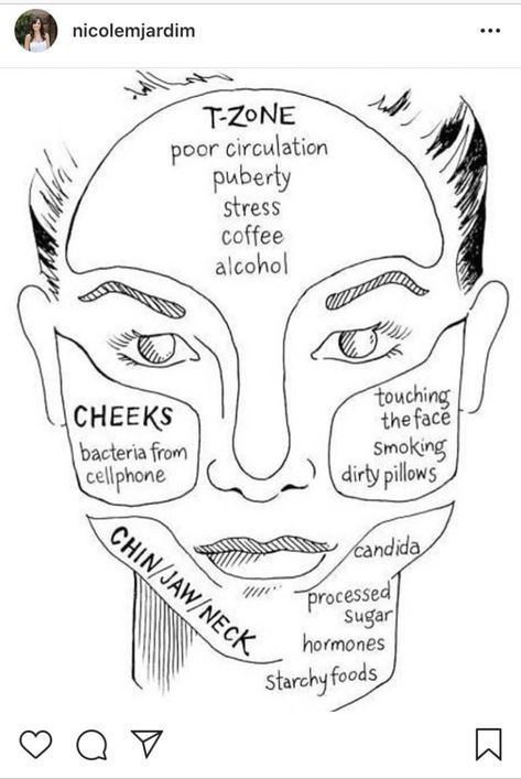 Gesicht Mapping, Food Acne, Jawline Acne, Nose Acne, Neck Acne, Face Map, Acne Hacks, Face Mapping Acne, Korean 10 Step Skin Care