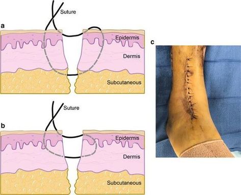 Picc Nurse, Medical Sutures, Surgical Stitches, Suture Techniques, Suture Material, Veterinary Nurse, Navy Corpsman, Surgical Suture, Surgical Technologist