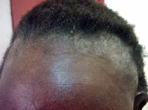 seborrheic dermatitis - Dandruff is considered a mild form of seborrheic dermatitis - In extreme cases you will notice not just flaking but extreme irritation with a lot of oil buildup on the scalp. Sebboric Dermitis Scalp, Seborrheic Dermitis On Face, Seborrheic Dermitis On Scalp, Easy High Ponytail Hairstyles, Easy High Ponytail, Dry Scalp Remedy, Ponytail Hack, Dry Flaky Scalp, Easy Ponytail