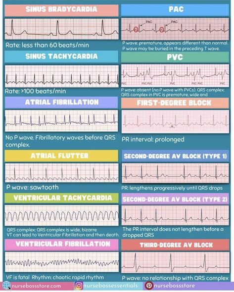 Nursing School Studying Cheat Sheets, Cardiology Nursing, Nurse Skills, Ekg Interpretation, Nursing School Essential, Nursing Study Guide, Nurse Study Notes, Nursing Student Tips, Medical Student Study