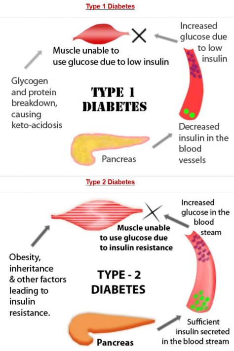 Medical Mnemonics, Nursing Tips, Nursing Notes, Medical Knowledge, Double Tap, Type 1, Disease, Tap, Medical