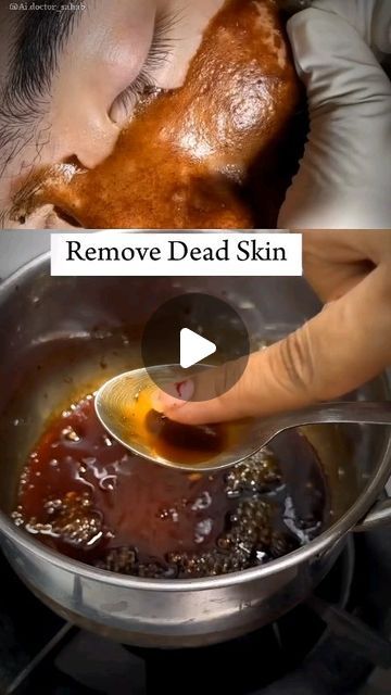 Face Pack For Blackheads, Dead Skin Removal Face, Diy Skin Mask, Black Head Remover Diy, Dead Skin On Face, Face Waxing, Diy Facial Hair Removal, Blackheads On Face, Blackhead Remover Diy