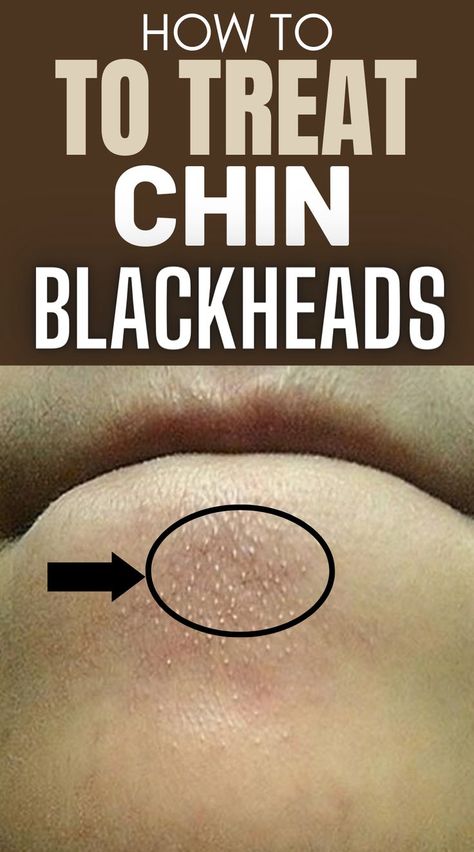 How to Quickly and Easily Remove Blackheads from Your Chin at Home Blackheads On Face, Blind Pimple, Blackheads On Nose, Face Pores, How To Get Rid Of Pimples, Remove Blackheads, Get Rid Of Blackheads, Unwanted Hair Removal, Homemade Face