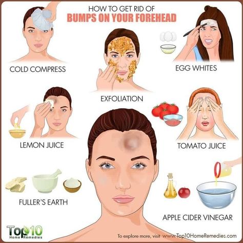 Tiny Bumps On Forehead, Bumps On Forehead, Small Bumps On Forehead, Forehead Bumps, Pimples On Forehead, Forehead Acne, Top 10 Home Remedies, Diy Dry Shampoo, How To Get Rid Of Pimples