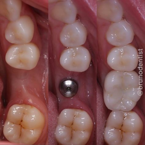 Dental Implants Before And After, Dental Animation, Tooth Implant, Affordable Dental Implants, Dental Images, Dental Posters, Dental Implant Surgery, Molar Tooth, Dental Anatomy