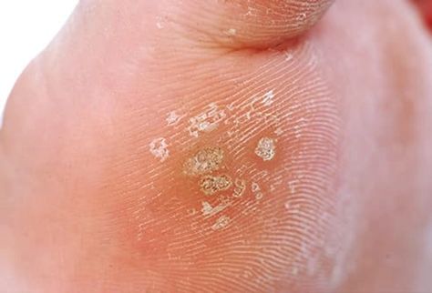 Plantar Wart Remedies, Viral Rash, Filiform Wart, Wart On Finger, Flat Warts, Plantar Warts, Types Of Warts, Facial Warts, Warts Remedy