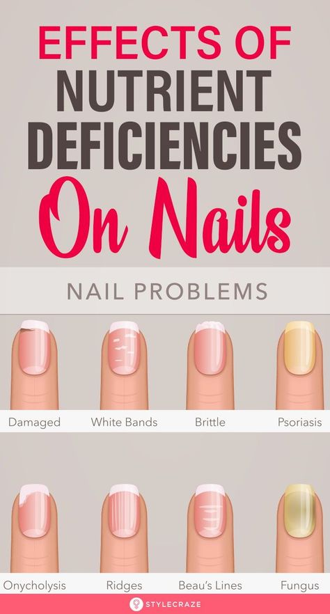 Effects Of Nutrient Deficiencies On Nails: Their shape, texture, color, growth rate – everything is a sign that your body is screaming for nutrients. Most of the changes in your nails and skin occur due to vitamin and nutrient deficiency. Here’s a list of symptoms that you may notice in your nails and what they mean for your health. #Nails #NailCare #NutritionDeficiency #NailCareTips Nail Health Signs, Nail Conditions, Nail Problems, Vitamin Deficiency, Health Signs, Magnesium Deficiency, Tongue Health, Nutrient Deficiency, Nail Care Tips