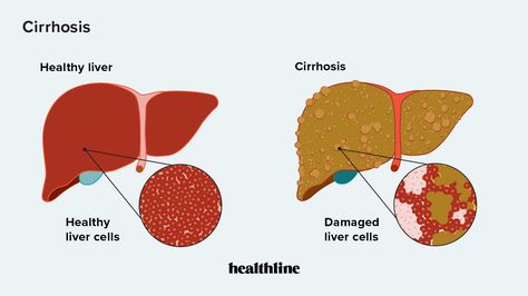 Liver Damage, Therapy Ball, Liver Failure, Bile Duct, Creation Story, Viral Infection, Healthy Liver, Scarring, Scar Tissue