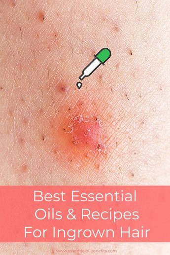 Ingrown Eyebrow Hair, Infected Hair Follicle, Infected Ingrown Hair, Treat Ingrown Hair, Hair Oil Recipe, Ingrown Hair Serum, Ingrown Hair Remedies, Nail Remedies, Ingrown Hairs