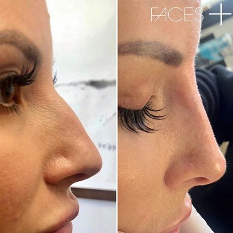 Nose Rhinoplasty, Nonsurgical Nose Job, Nose Surgery Rhinoplasty, Nose Fillers, Rhinoplasty Nose Jobs, Face Fillers, Pretty Nose, Facial Fillers, Perfect Nose