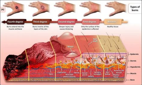 Burn Wound Care, Burns Nursing, Burn Wound, Types Of Burns, Wound Care Nursing, How To Heal Burns, All Body Systems, Burn Injury, Severe Burns