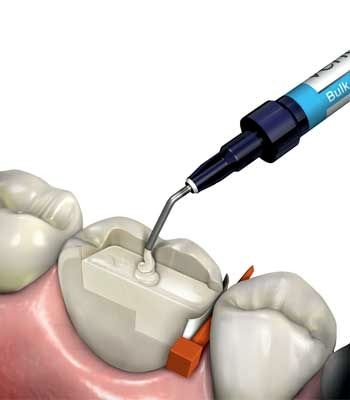 Dental Composites in 2017: Types and Recommendations Dental Animation, Dental Composite, Metal Manufacturing, Urban Wall, Photoshop Tutorial Photo Editing, Dental Products, Dental Art, Botox Injections, Dental Instruments