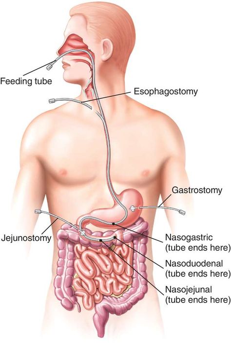 Ryles Tube Feeding, Gastrostomy Tube, Enteral Feeding, Tube Feeding, Health Equipment, Beautiful Profile, Beautiful Profile Pictures, Feeding Tube, Art Comic