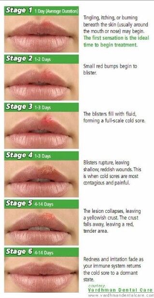 Cold sore stages Lip Sores, Cold Sore Stages, Cold Sore Lip, Cold Sore Remedy, Sore Lips, Fever Blister, Cold Sore Remedies, Canker Sore, Cold Sores