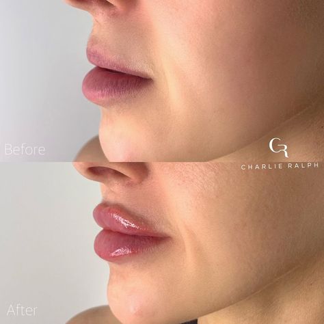 Charlie Ralph on Instagram: “Side profile before and after lip filler 💉🙌🏽 Bringing out that top lip by adding more volume and hydration 👩🏽‍⚕️ Cosmetic Nurse Charlie…” Lip Filler Top Lip Only, Lips Before And After, Lip Filler Side Profile, Heavy Lower Lip, Before And After Lip Fillers, Lip Filler Before And After, After Lip Fillers, Cosmetic Nurse, Lip Surgery