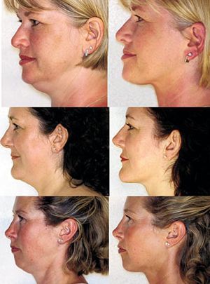 Face Rubbing: Get A Non-Surgical Turtle Neck Lift Via This Minimal Facial Exercise Jowls Exercises, Face Gym, Facial Exercise, Double Chin Exercises, Chin Exercises, Natural Face Lift, Face Yoga Exercises, Turkey Neck, Facial Toning