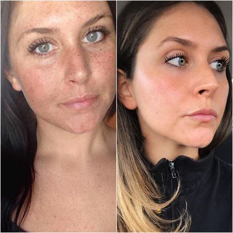 A woman on Reddit shared a before-and-after photo of her sun damage, four years apart. Find out the exact products she used to heal her sun damage. Creme Anti Age, Sun Damaged Skin, Foaming Facial Cleanser, Glow Skin, First Aid Beauty, Mario Badescu, Glowy Skin, Anti Aging Tips, Sun Damage