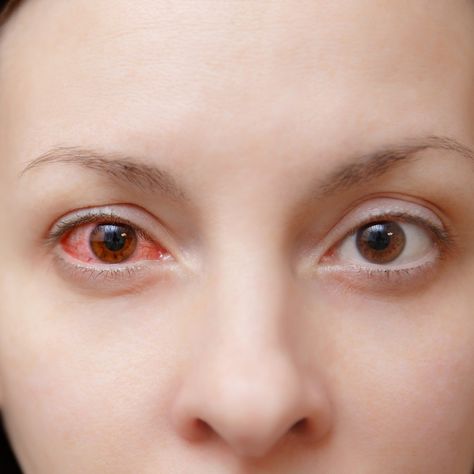 Close up of one annoyed red blood and health eye of female affected by conjunctivitis or after flu cold or allergy in... Red Eyes Remedy, Treating Pink Eye, Pink Eye Home Remedies, Pinkeye Remedies, Allergy Eyes, Cold Or Allergies, Parts Of The Eye, Eye Vitamins, Irritated Eye