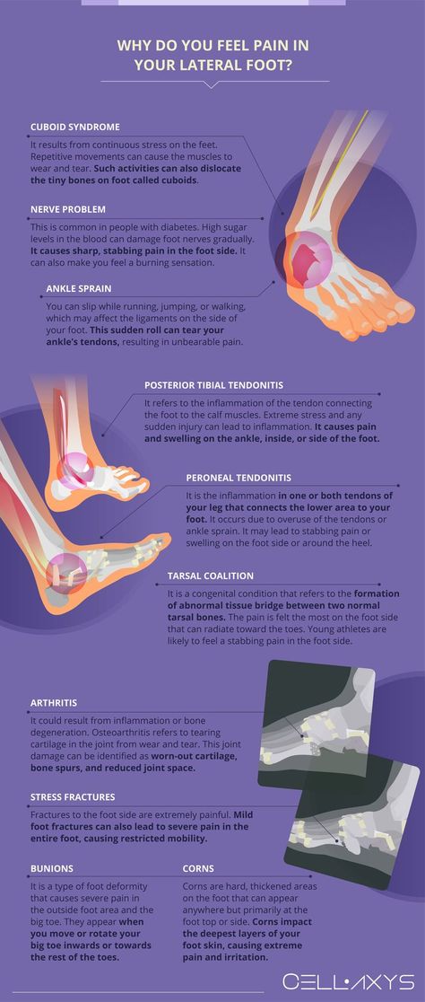 Why Do You Feel Pain in Your Lateral Foot Foot Pain Chart, Cuboid Syndrome, Ankle Pain Relief, Achilles Pain, Physical Therapy Exercises, Foot Pain Relief, Ankle Pain, Pain Relief Cream, Nerve Pain Relief