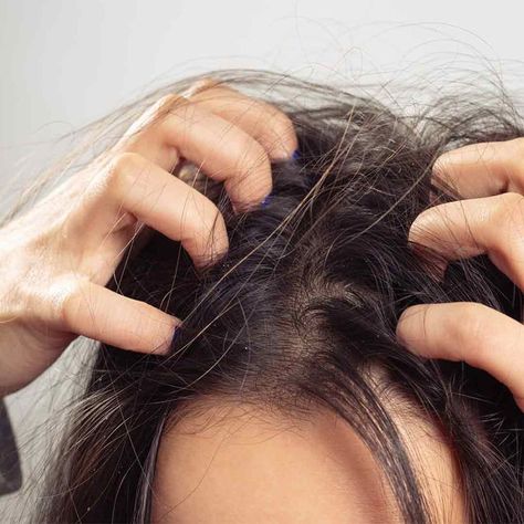 Itchy Scalp How To Remove Dandruff, Flaky Scalp, Hair Concerns, Itchy Scalp, Scalp Conditions, Healthy Scalp, Les Rides, Hair Care Routine, Dandruff