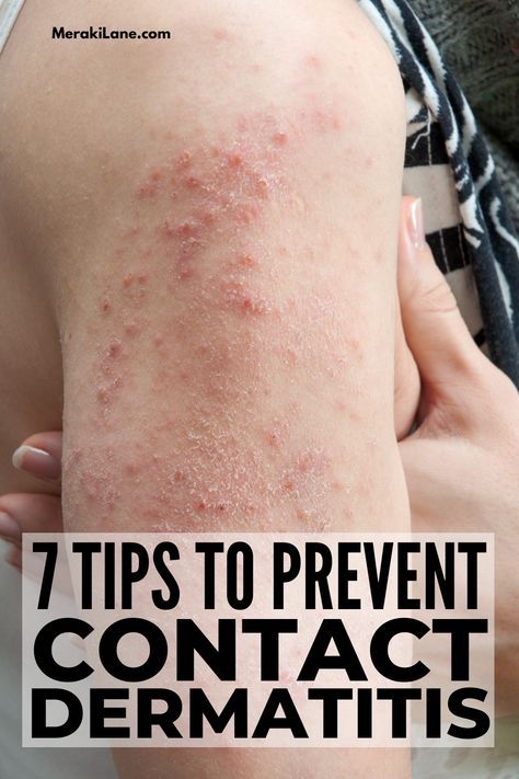 12 Prevention Tips and Natural Remedies for Contact Dermatitis | What is contact dermititis, what causes it, what are the symptoms, and what can be done to treat and prevent this inflammatory skin condition and the red, itchy, blistery rash it creates? We're answering all of these questions - and more! Click for the best natural remedies for contact dermatitis that are safe for babies, kids, and adults, plus preventative tips and home remedies to help you avoid future flare ups! Skin Rash Remedies, Heat Rash Remedy, Skin Rashes Pictures, Home Remedies For Rashes, Rash On Hands, Itchy Skin Rash, Itchy Skin Remedy, Rash On Face, Rashes Remedies