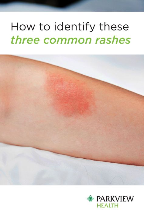 Red Rashes On Skin, Skin Rashes Pictures, Leg Rash, Common Skin Rashes, Itchy Skin Rash, Body Rash, Rash On Neck, Red Rash, Itchy Rash