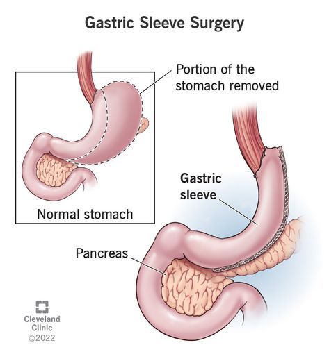 Gastric Sleeve Surgery: What it Is, Requirements Sleeve Operation, Sleeve Gastrectomy, Sleeve Surgery, General Surgery, Liquid Diet, Health Screening, Cleveland Clinic, Health Articles, Medical Conditions