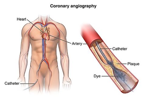 Heart Catheterization, Heart Arteries, Enlarged Heart, Heart Valves, Medical Business, Congenital Heart, Heart Care, Heart Muscle, Coronary Arteries