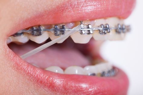 Braces With Rubber Bands, Braces Girl, Braces Color Wheel, Braces Ideas, Braces Retainer, Braces Rubber Bands, Braces Pain, Braces Bands, Types Of Braces