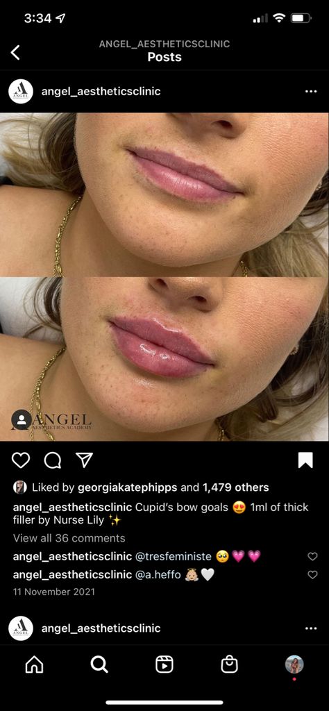 Hailey Beiber Lips Before And After, Lip Filler Before And After Round Lips, Natural Looking Filled Lips, Lip Fuller Shapes, M Shape Lips, Lip Fillers Cupids Bow, Small Lip Injections Before And After, Light Lip Injections, Lip Filler Transformation