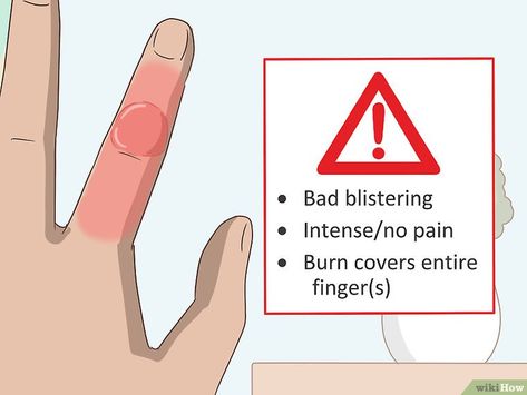 How To Treat A Burn Skin, Burned Skin Remedies, Burn Blister, How To Treat Blisters, Water Blister, Curling Iron Burn, Blister Remedies, 2nd Degree Burns, Burned Finger