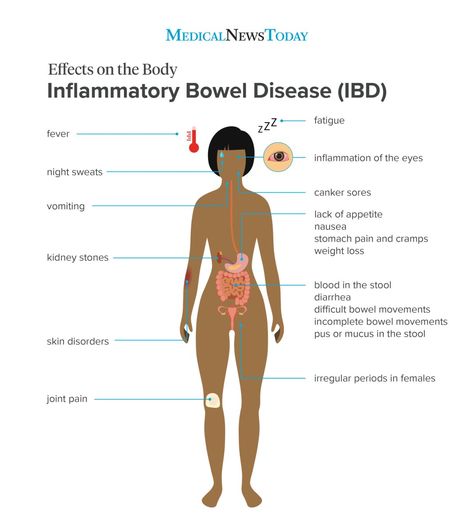 Many people think that Crohnâs and Colitis (IBD) only affects the intestines. While you would be right that IBD is an inflammatory disease of the intestines, it has the ability to change much more than digestion. IBD has been shown to affect the eyes, skin, mouth, joints, blood, bones, and kidneys. Check it out in this weeks blog post HERE! Ibd Symptoms, Gastrointestinal Disease, Inflammatory Bowel, Medical Posters, Canker Sore, Beautifully Broken, Disease Symptoms, Stomach Pain, Skin Disorders