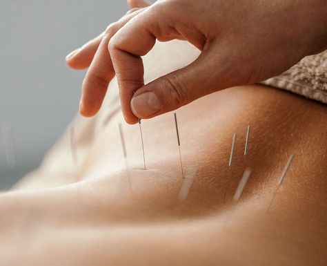 Acupuncture is a traditional Chinese method used to relieve some health conditions and symptoms, such as pain. Learn more about this technique. Sleeping Issues, Acupuncture Clinic, Root Chakra Stones, Tattoos Infinity, Tattoos Mandala, Trigger Point Therapy, Inspiration Tattoo, Western Medicine, Tattoos Geometric