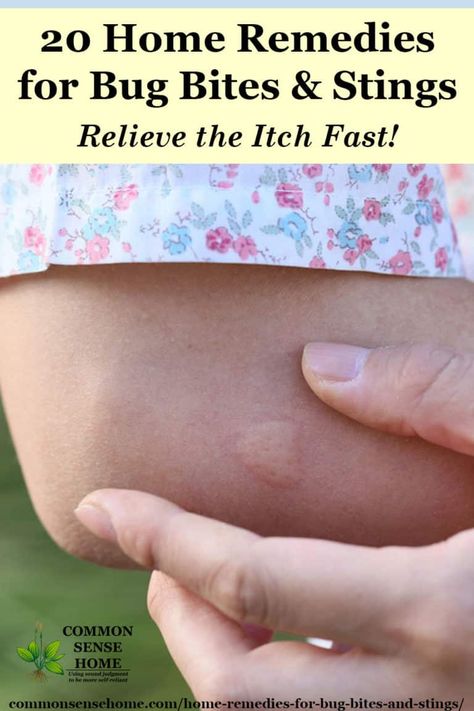 Mosquito Bite Itch Relief, Bug Bite Itch Relief, Remedies For Bug Bites, Wasp Sting Remedy, Mosquito Bite Relief, Bug Bite Itch, Mosquito Bite Itch, Itchy Bug Bites, Remedies For Mosquito Bites