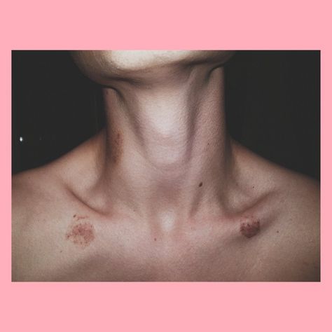 Hicks On Neck Aesthetic, Aesthetics Hickeys, Hickey Neck Aesthetique, Love Bites Hickey For Boys, Love Bites Hickey, 2024 Relationship, Neck Full Of Hickeys, Hicks On Neck, Hickies Neck Aesthetic