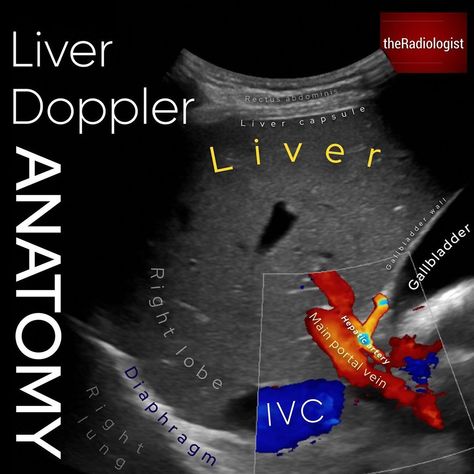 The Radiologist on Instagram: “⁣ ULTRASOUND DOPPLER⁣ ⁣ 👨🏽‍💻Here we are looking at an ultrasound of the liver with Doppler images showing us flow within the main portal…” Abdominal Ultrasound, Medical Sonography, Ultrasound Sonography, Medical Ultrasound, Diagnostic Medical Sonography, Ultrasound Technician, The Liver, Nurse Practitioner, Radiology