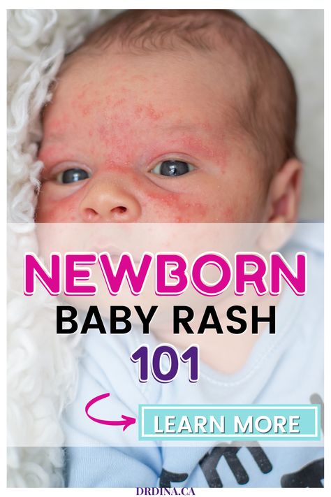 Parents often seek advice about rashes or skin changes their babies are born with or develop in the first few weeks or months of life. Rashes commonly cause stress for parents, as we want our kids to have flawless skin! Here we will review the most common rashes we see in the newborn and young-baby stages. Face Rash Remedies, Newborn Dry Skin, Newborn Rash, Skin Rash On Face, Viral Rash, Baby Rashes, Baby Skin Rash, Rash On Face, Rashes Remedies