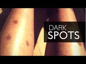 HOW TO GET RID OF DARK SPOTS ON LEGS & BODY FAST | GET CLEAR EVEN SKIN TONE ALL OVER! - YouTube Hyperpigmentation On Legs Dark Spots, Dark Spots And Hyperpigmentation, Black Spots On Legs Remove, Dark Spots On Legs Remove Diy, How To Get Rid Of Scabs On Legs Fast, How To Get Rid Of Old Scars On Legs Fast, Black Spots On Face Remove Fast, Black Elbows Get Rid Of, How To Get Rid Of Dark Spots On Legs Diy