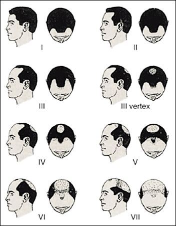 Norwood-Hamilton Scale of Male Pattern Baldness, published in Expert Reviews of Molecular Medicine by Cambridge University Press 2002- 2013 Hairstyles for Men with Balding Thinning Hair Style Cuts Trends by Rosie2010 Thinning Hair Style, Male Pattern Baldness Hairstyles, 2013 Hairstyles, Losing Hair Women, Baldness Solutions, Thick Hair Remedies, Female Pattern Baldness, Male Pattern Baldness, Hair Remedies For Growth