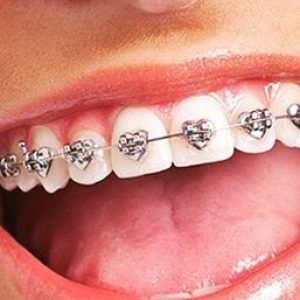 braces with love hearts for valentines dentist Aesthetic Braces, Dental Braces Colors, Kawat Gigi, Teeth Images, Cute Braces Colors, Braces Cost, Amazing Aesthetic, Braces Tips, Getting Braces