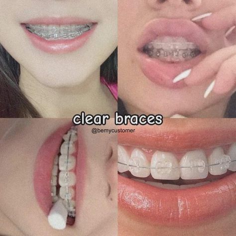 Clear Braces With Color Bands, Porcelain Braces, Brackets Aesthetic, White Braces, Braces Colors Ideas, Silver Braces, Kawat Gigi, Ceramic Braces, Cute Braces Colors