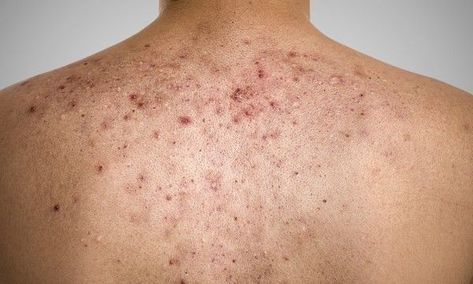 Whether the pockmarks are superficial or deep, it is possible to get rid of acne scars on the back. Methods vary according to the condition of your skin. Hormonal Acne Remedies, Back Acne Remedies, Chest Acne, Forehead Acne, Diy Acne, Get Rid Of Acne, Rid Of Acne, Acne Face Wash, Acne Remedies