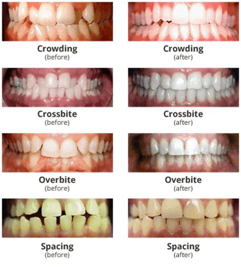 Braces With Crooked Teeth, Overbite Aesthetic, Braces On Crooked Teeth, Braces With Gap Teeth, Aligners For Teeth, Crossbite Teeth, Gap Teeth Aesthetic, Crooked Teeth Aesthetic, Crowding Teeth