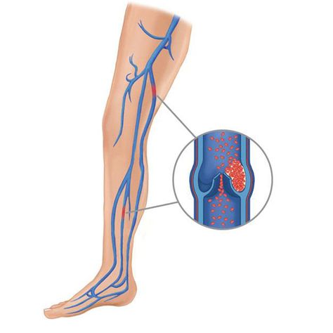 Vein Thrombosis, Swollen Legs, Poor Circulation, Women Health Care, Compression Stockings, Fluid Retention, Improve Blood Circulation, Health Risks, Compression Socks