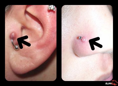 Majority of people complain about bumps on their piercings. Usually with proper care, piercing spots can be kept from forming, however sometimes these get a bump with the best of care Piercing Spots, Nose Piercing Bump, Piercing Bump, Skin Piercing, Numbing Cream, Piercing Aftercare, Butterfly Earrings Stud, The Other Half, Rose Necklace