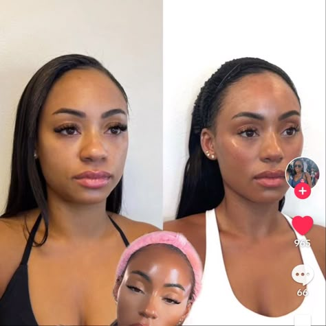 Face Plastic Surgery Before After, Botox Black Women, Beauty Procedures Aesthetic, Filler Black Women, Alarplasty Before After, Facial Balancing Before And After, Cosmetic Surgery Aesthetic, Face Fillers Before And After, Face Contouring Fillers